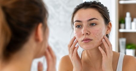 Πόσο αποτελεσματικές είναι οι δημοφιλείς θεραπείες ακμής;